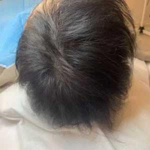 Haar-mesotheraphie-1