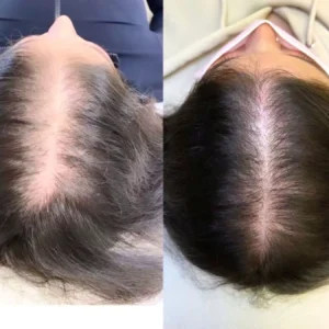 Haar-mesotheraphie-3