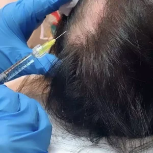 Haar-mesotheraphie-5
