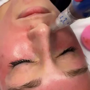 Microneedling-1