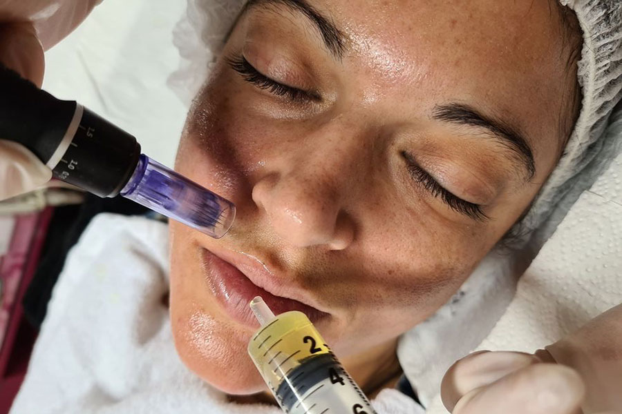 Microneedling is een nieuwe huidverjongingstechniek 2