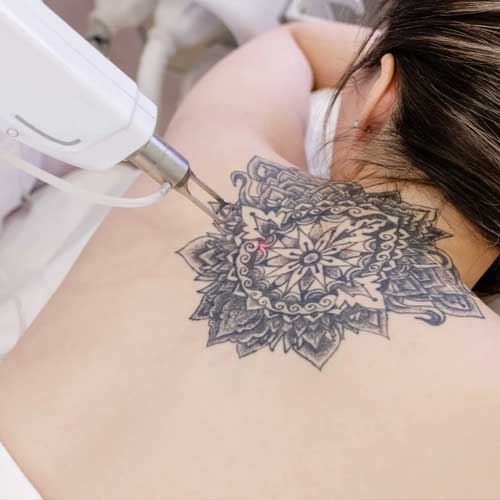 tattoo removal
