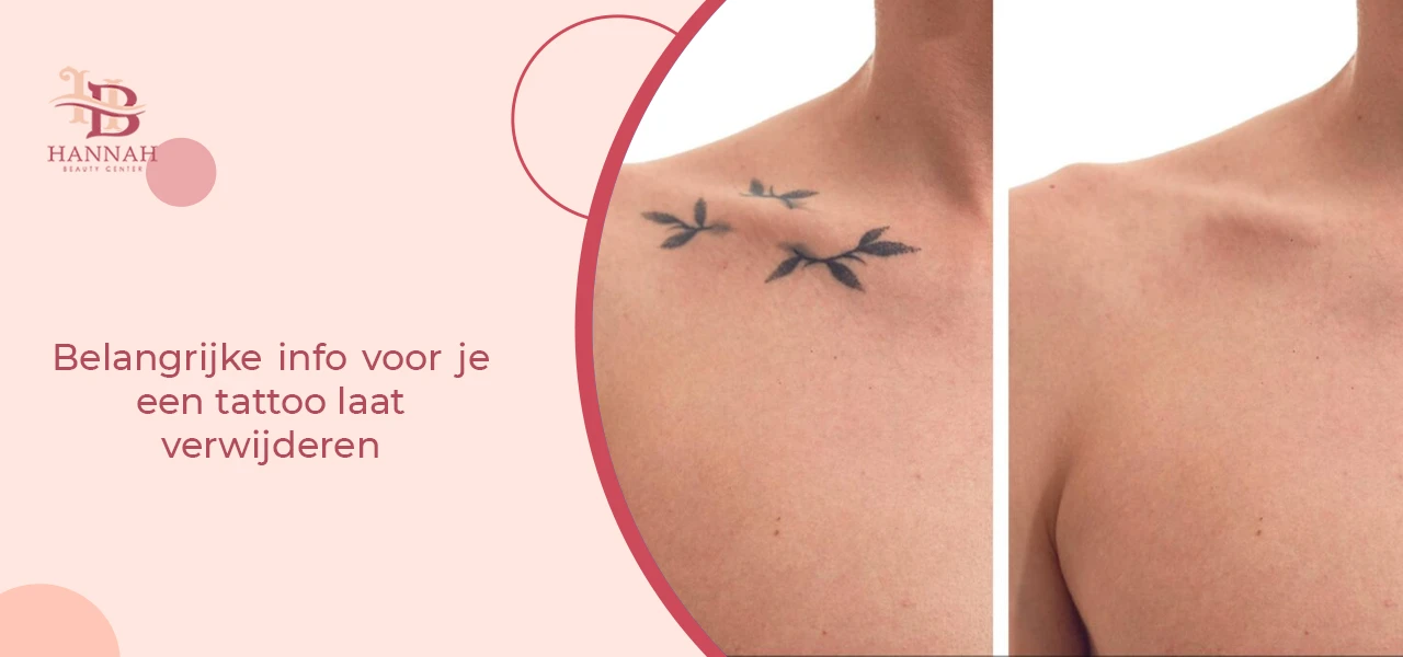 Belangrijke info voor je een tattoo laat verwijderen