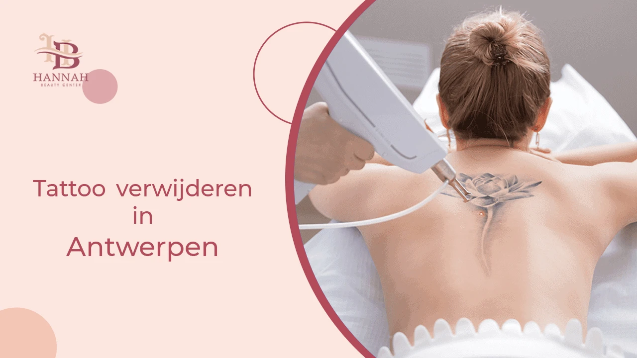Tattoo verwijderen in Antwerpen