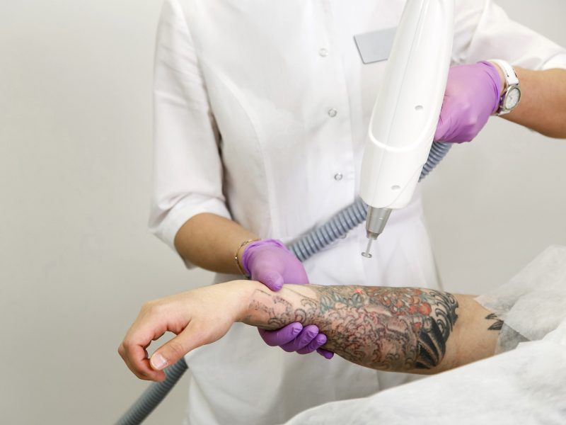 cosmetologist-with-patient-professional-tattoo-removal-laser-from-hand-salon_247889-16 cosmetologist with patient professional tattoo removal laser from hand salon 247889 16 2